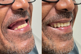 Prótese Dentária de Um Senhor. Antes e Depois.